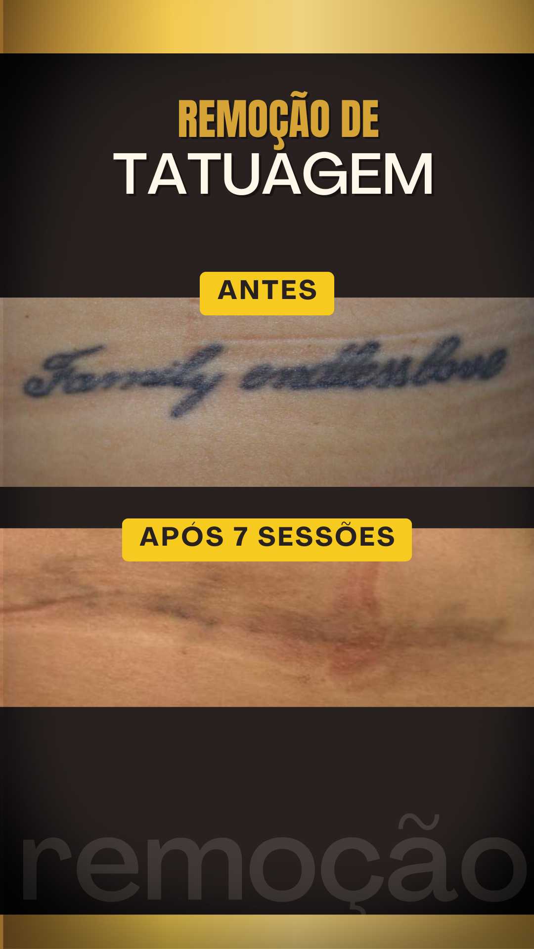 Remoção de tatuagem